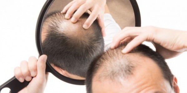Alopecia androgenetica: di che cosa si tratta esattamente e quali sono le cause?